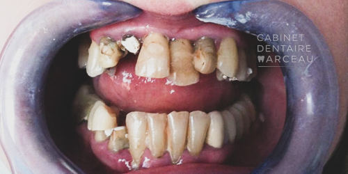 Avant - Cas Clinique - Cabinet Dentaire Marceau Montreuil