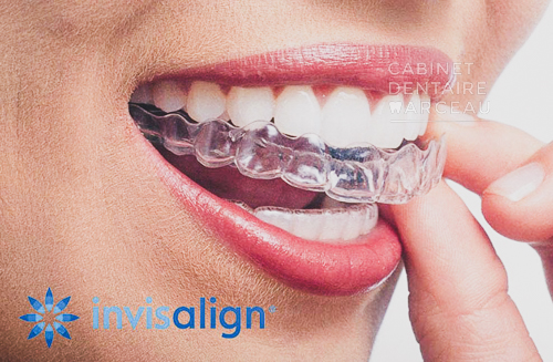 Invisalign - Cabinet Dentaire Marceau à Montreuil