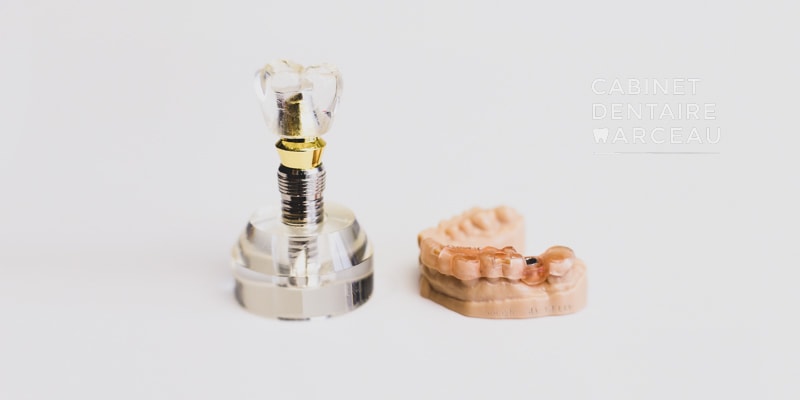 Implant dentaire - Cabinet Dentaire Marceau à Montreuil